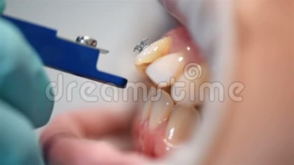 牙医检查支架安装情况视频的预览图