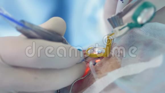 手指在眼科手术中慢慢地在百叶窗下移动医疗工具视频的预览图