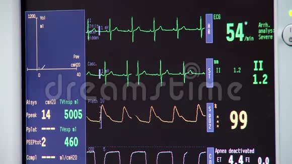 急诊室的心电图视频的预览图
