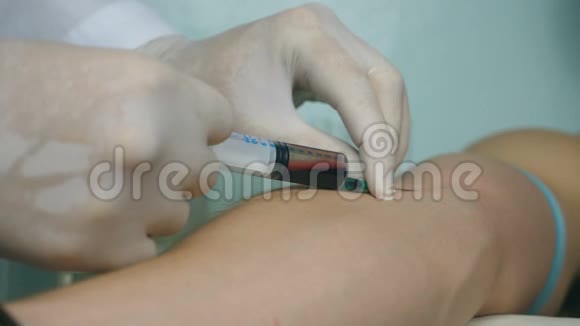 医生的手从病人的静脉中提取注射器做个血样化验医生取血的手臂视频的预览图