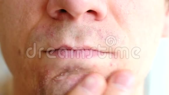 剃须后皮肤刺激男人在下巴特写上揉着他的手疙瘩视频的预览图