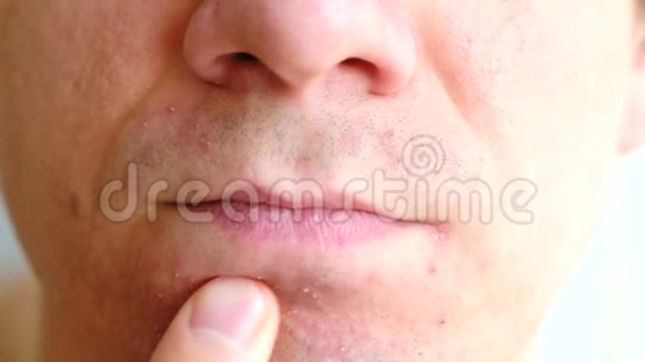 剃须后皮肤刺激男人在下巴特写上揉着他的手疙瘩视频的预览图