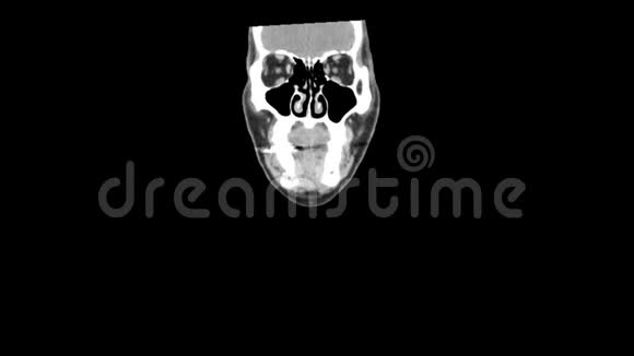 CT扫描整个颈部平滑运动视频的预览图
