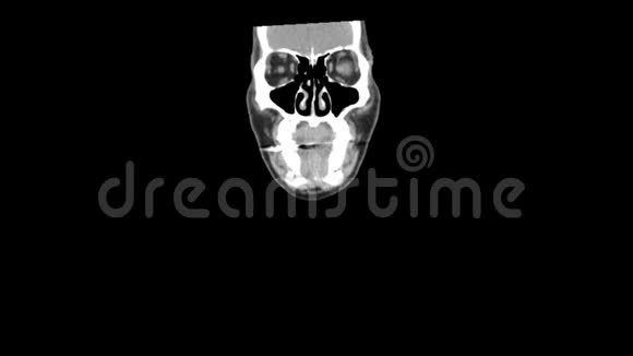 CT扫描整个颈部平滑运动视频的预览图