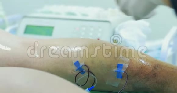 患者老年妇女s腿血栓形成蜘蛛静脉静脉曲张手术前视频的预览图