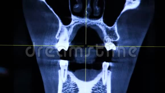 牙痛症状电脑上人下巴的X光片医生检查病人下巴治疗牙齿视频的预览图