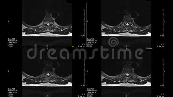 医生检查胸椎的真实MRI扫描视频的预览图