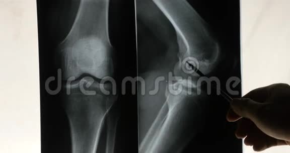 医生研究手臂腿部关节X线片进行分析医疗卫生医院视频的预览图