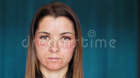 脸上有血肿的女孩分数激光美容程序的后果视频的预览图