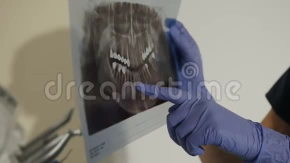 牙医手中牙齿的X光片一位女牙医在X线片上给一位年轻人了一颗生病的牙齿视频的预览图