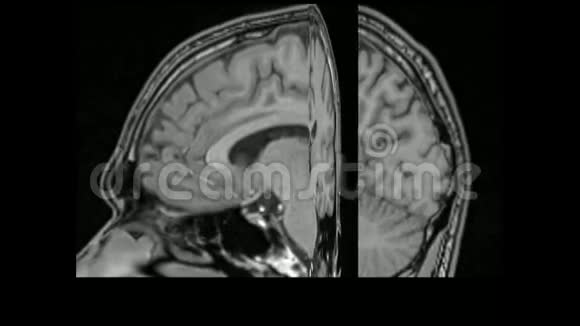 MRI脑三维旋转视频的预览图