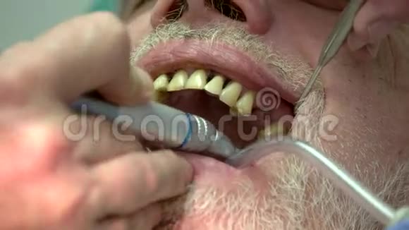 牙医抛光牙齿关闭视频的预览图