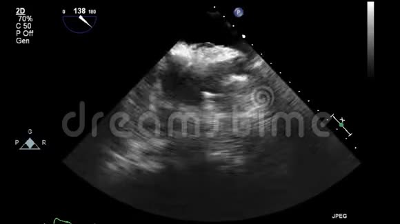 灰色模式下高质量的经食管超声视频视频的预览图