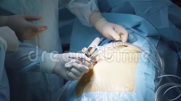 两个外科医生插入腹腔镜的手视频的预览图