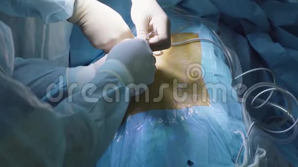 两个外科医生插入腹腔镜的手视频的预览图