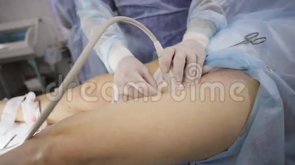 静脉曲张硬化治疗程序一种创新的手术方法视频的预览图