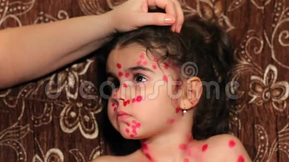 漂亮的小女孩有水痘孩子脸贴紧女性手臂用药物在脸上涂抹出疹视频的预览图