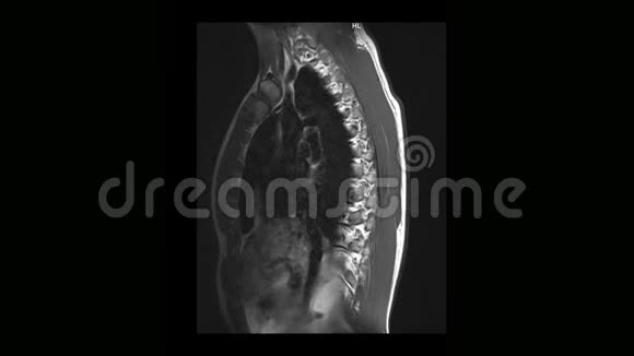 骨软骨病患者胸椎MRI计算机断层扫描视频的预览图