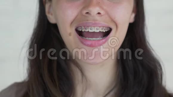 戴牙套的年轻女孩看着摄像机微笑着快关门视频的预览图