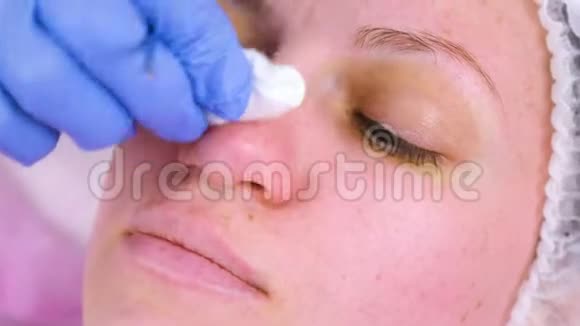 美容师的面部机械清洁美容医生把痤疮挤在病人鼻子上视频的预览图