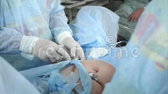 手术室的外科小组做翻领手术视频的预览图