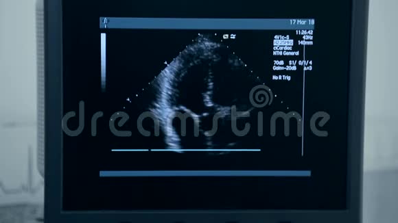 超声机带监护仪心脏检查视频的预览图
