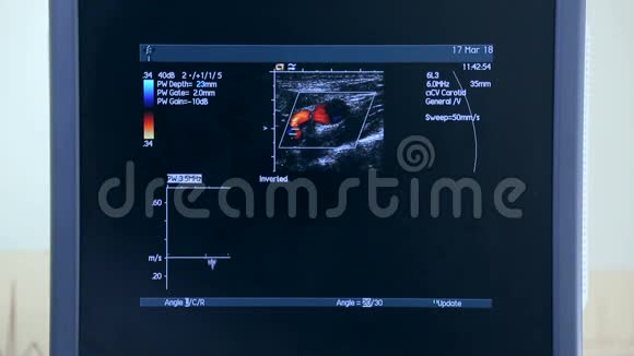 超声机带监护仪心脏检查视频的预览图