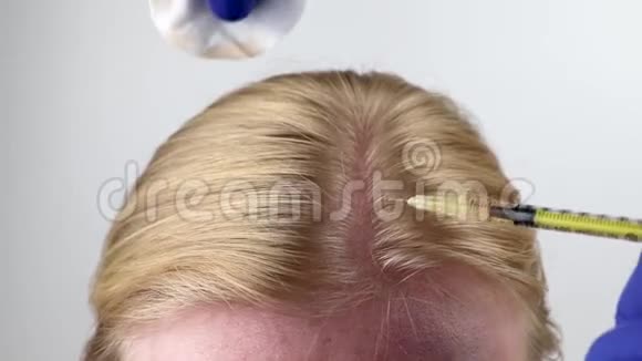 美容或头发移植美容医生在女性头部注射头发或防止头发生长视频的预览图