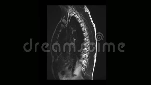 骨软骨病患者胸椎MRI计算机断层扫描视频的预览图