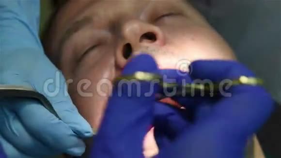牙医缝口香糖视频的预览图