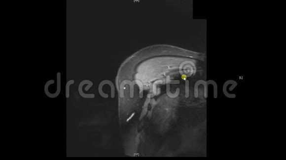 真正的MRI扫描医生检查男性肩部发现病变水肿和非常罕见的副乳腺囊肿视频的预览图