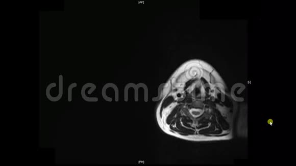 真正的MRI扫描医生检查男性肩部发现病变水肿和非常罕见的副乳腺囊肿视频的预览图