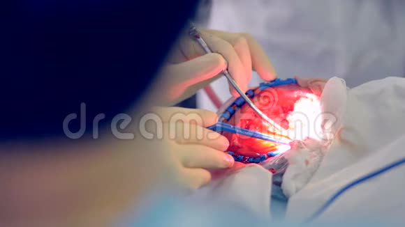 手在外科手套中使用消毒设备进行手术4K视频的预览图