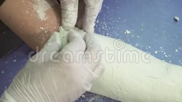 创伤科的创伤医生在病人的手臂上贴上石膏绷带视频的预览图