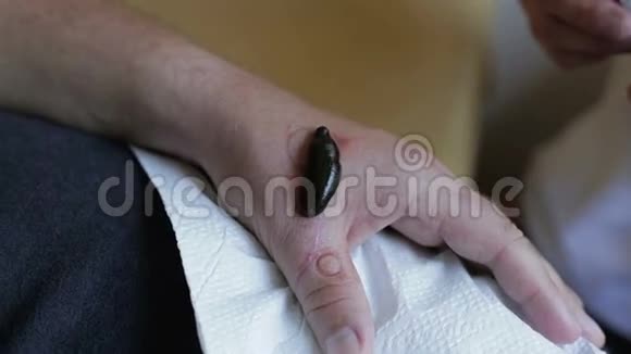 医用水蛭是从病人手臂吸血视频的预览图
