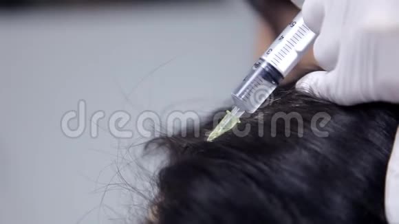 在临床上美容医生为病人做了中间疗法注射以改善头发的状况关闭视频的预览图