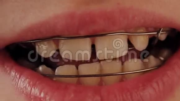 牙齿上的牙板视频的预览图