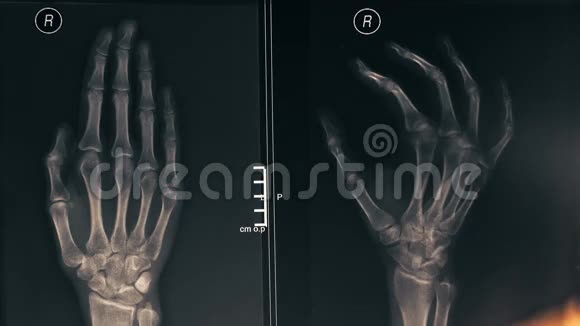 女医生向病人展示一只手的x光图像4K型特写镜头视频的预览图