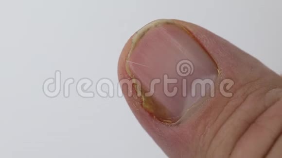 拇指手指上的指甲真菌感染视频的预览图