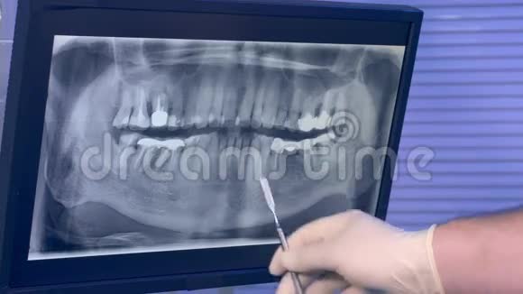 牙齿的X光全景图片和牙医用工具的手在屏幕上移动视频的预览图