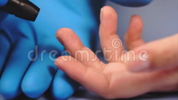 医生用柳叶刀对女性病人的手指手指上的血迹视频的预览图