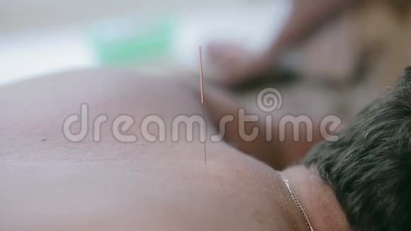 针刺针从病人的背部伸出视频的预览图
