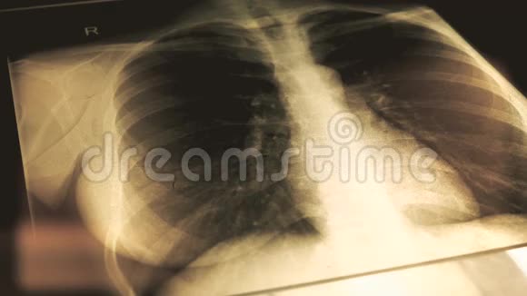 医生向病人解释胸部x线图像4K型特写镜头视频的预览图