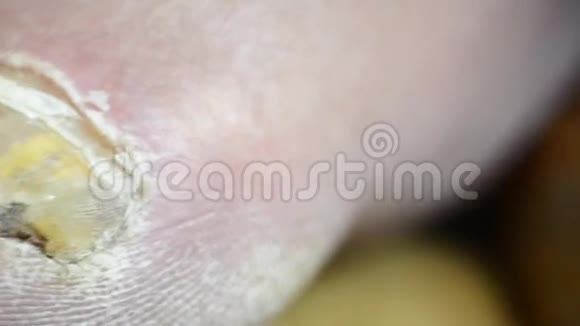 常见真菌感染的趾甲视频的预览图
