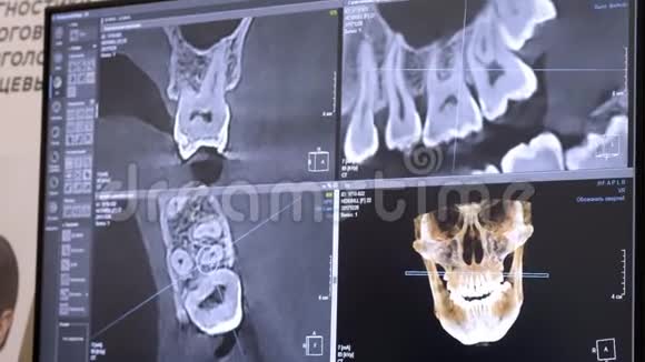 3D牙科数字建模修复三维牙齿模型病人扫描牙齿医生正在研究视频的预览图