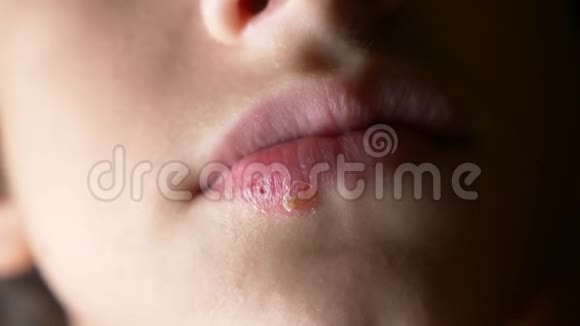 一个男孩嘴唇上的疱疹疱疹唇部治疗4k慢镜头拍摄复制空间视频的预览图