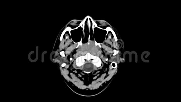 头顶视上脑CT扫描视频的预览图