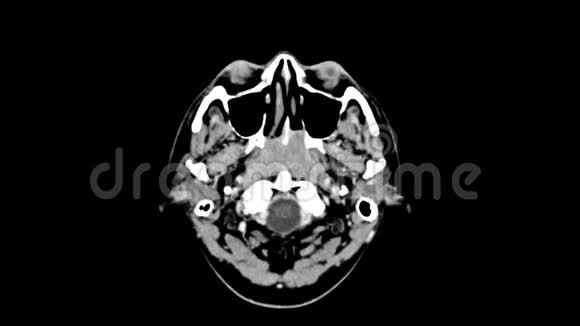头顶视上脑CT扫描视频的预览图