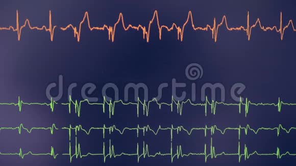 心脏造影心电示波器显示屏幕上的心跳率视频的预览图