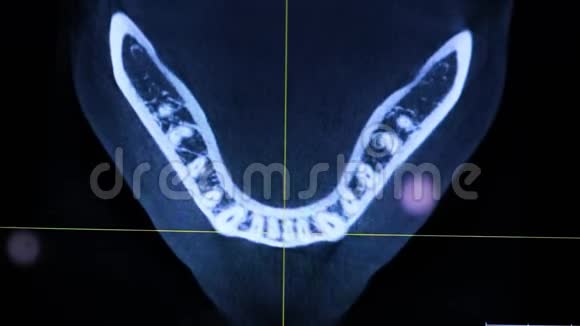 牙痛症状电脑上人下巴的X光片医生检查病人下巴治疗牙齿视频的预览图